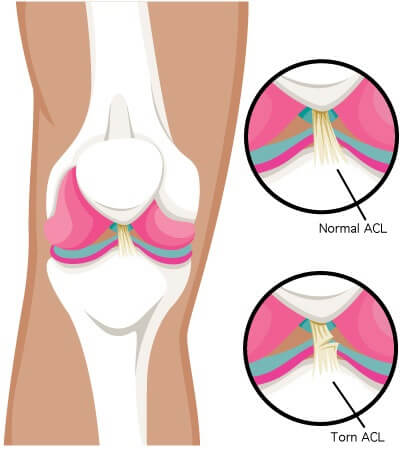 ACL Diagram