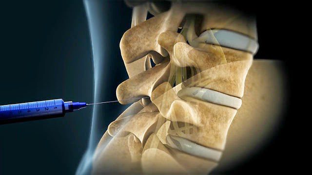 epidural-injections-nyc-doctors-manhattan