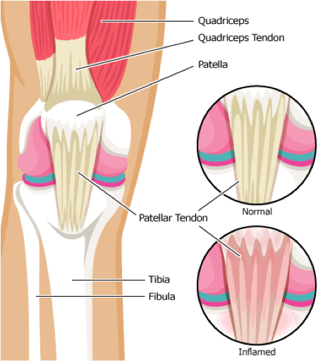 knee tendonitis doctor nyc