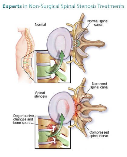 Spinal Stenosis Treatment