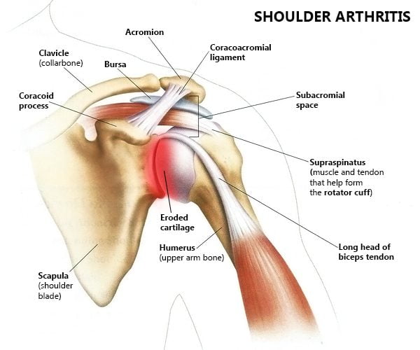 Shoulder Arthritis Treatment