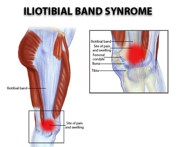 Iliotibial Band Syndrome Treatment & Management: Acute Phase