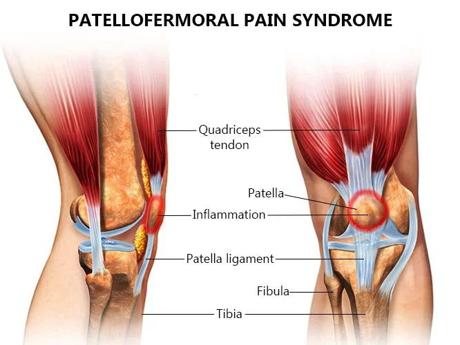 Patellofemoral Pain Syndrome Treatment in NYC New York Pain Care