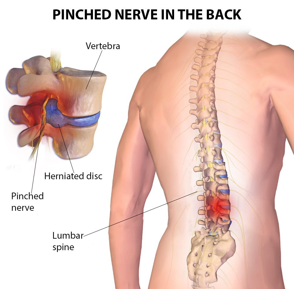 How Do You Treat a Pinched Nerve?