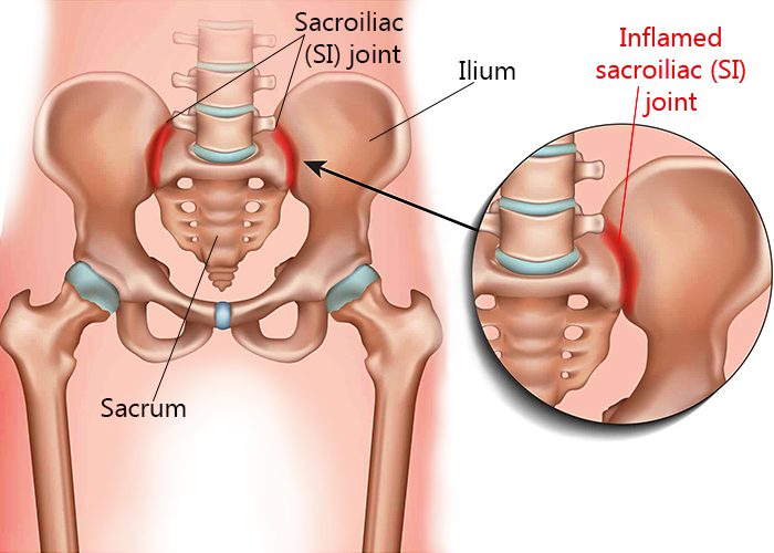 Sacroiliac (SI) Joint Pain: Causes, Symptoms, Treatment