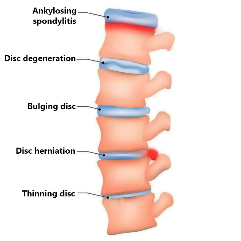 Anatomy of back pain