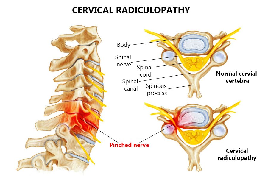 Pinched Nerve Specialist in NYC