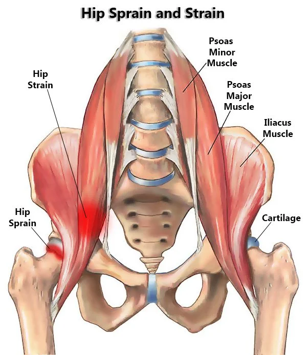 hip sprain and strain