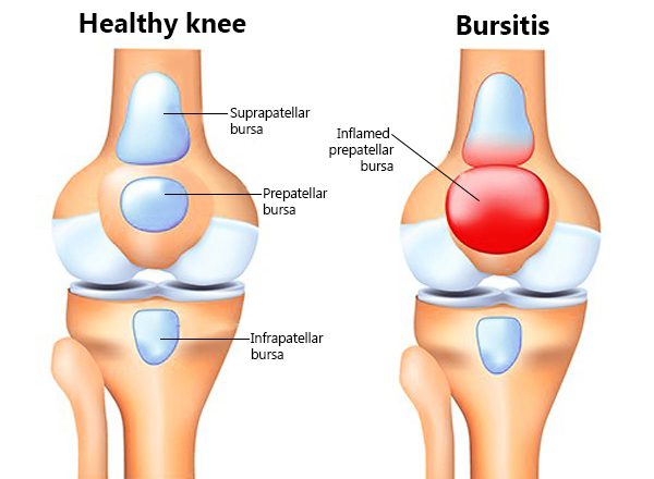 Bursitis. Healthy knee and knee with bursitis
