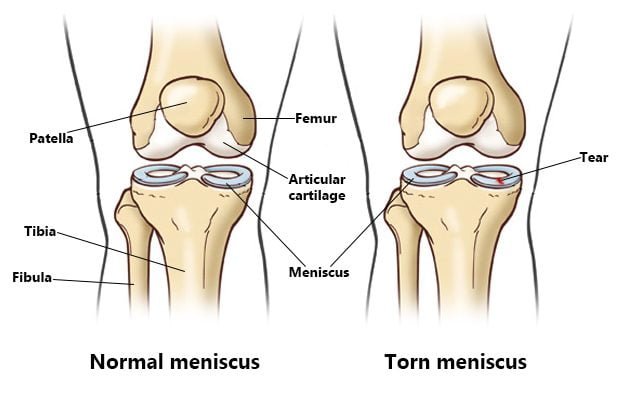 Anatomy of the Meniscus Tear