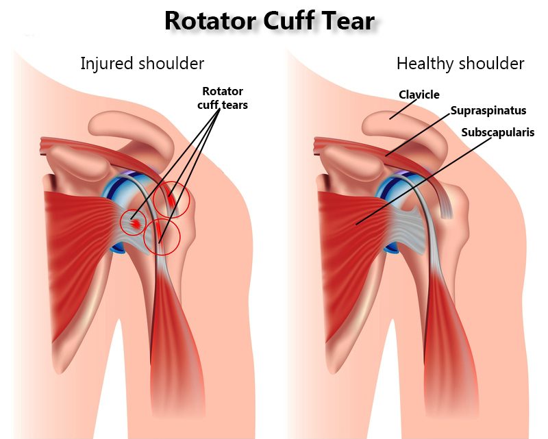 Rotator Cuff Tear Treatment Specialists in NYC