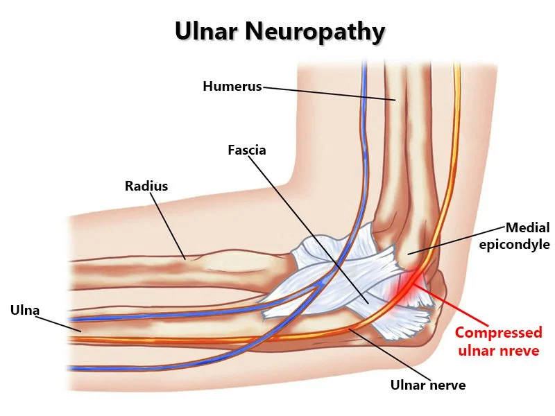 ulnar neuropathy