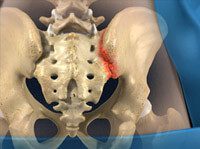 Sacroiliac Joint Injection
