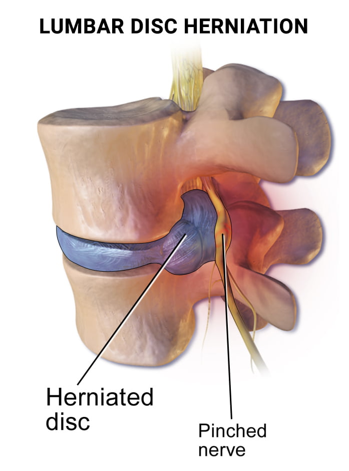 Herniated Disc: Symptoms, Causes, Diagnosis & Treatments - Mater