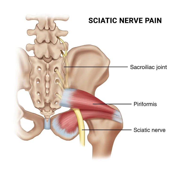 Heel pain sciatica deals