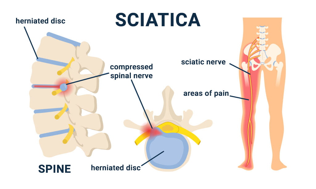 5 causes of left and right flank pain