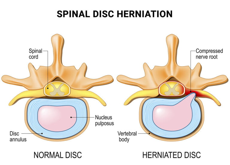 What Are The Symptoms Of A C5-C6 Bulging Disc?