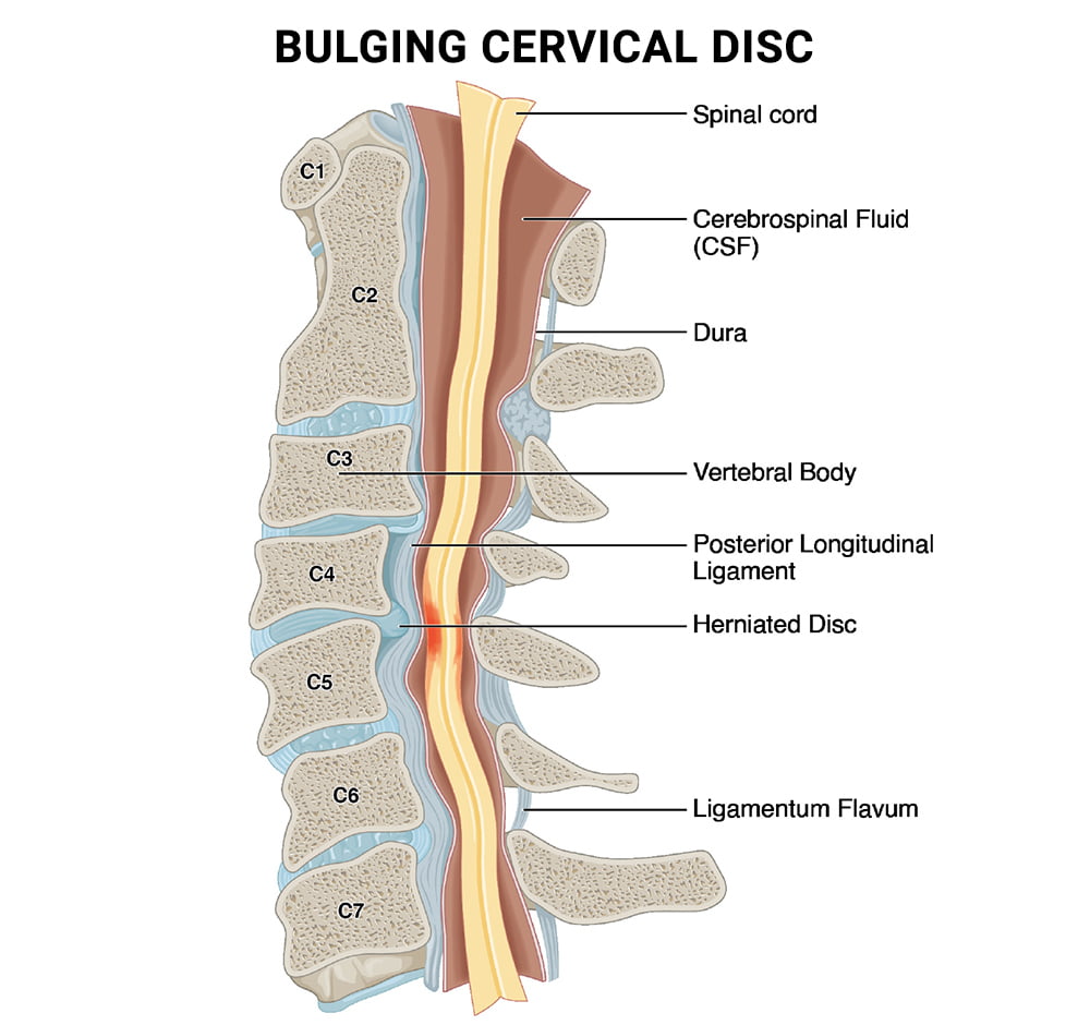 Is it a Herniated Disc, a Bulging Disc, or a Pinched Nerve? - Accent on  Health Chiropractic