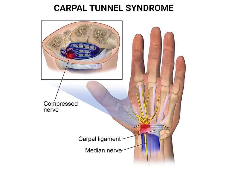 cjc-1295 ipamorelin side effects water retention carpal tunnel Carpal Tunnel Syndrome Treatment NYC