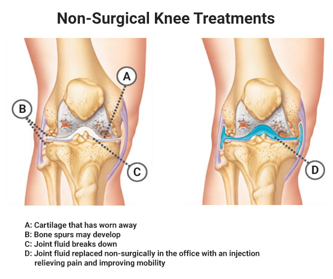 Knee Pain Treatment NYC