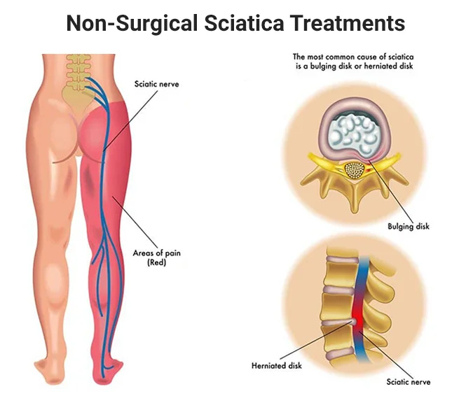 Sciatica Treatment NYC