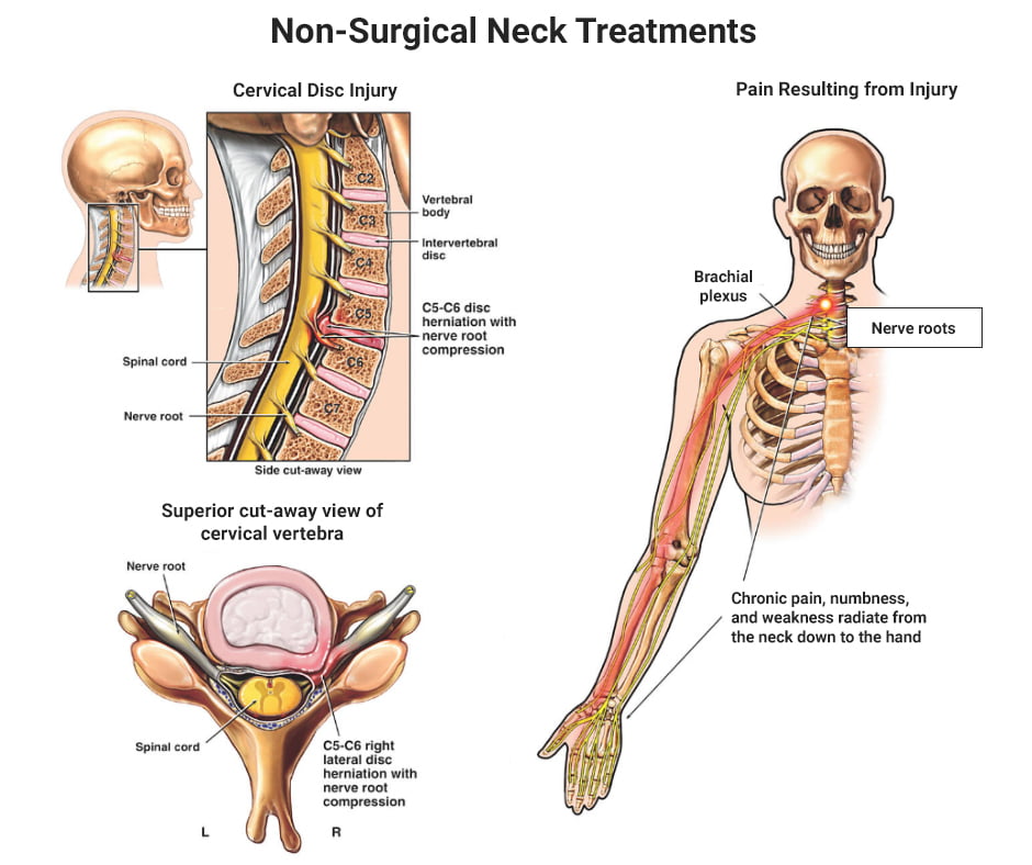 Neck Pain Relief, Severe, Chronic Neck Pain Treatment