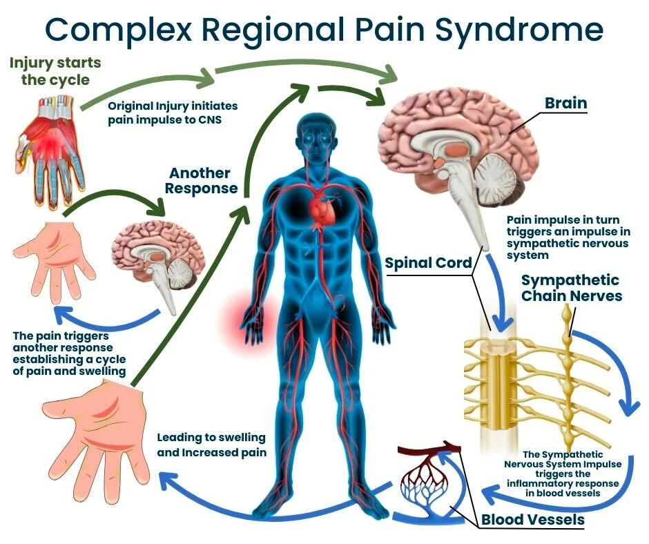Complex Regional Pain Syndrome