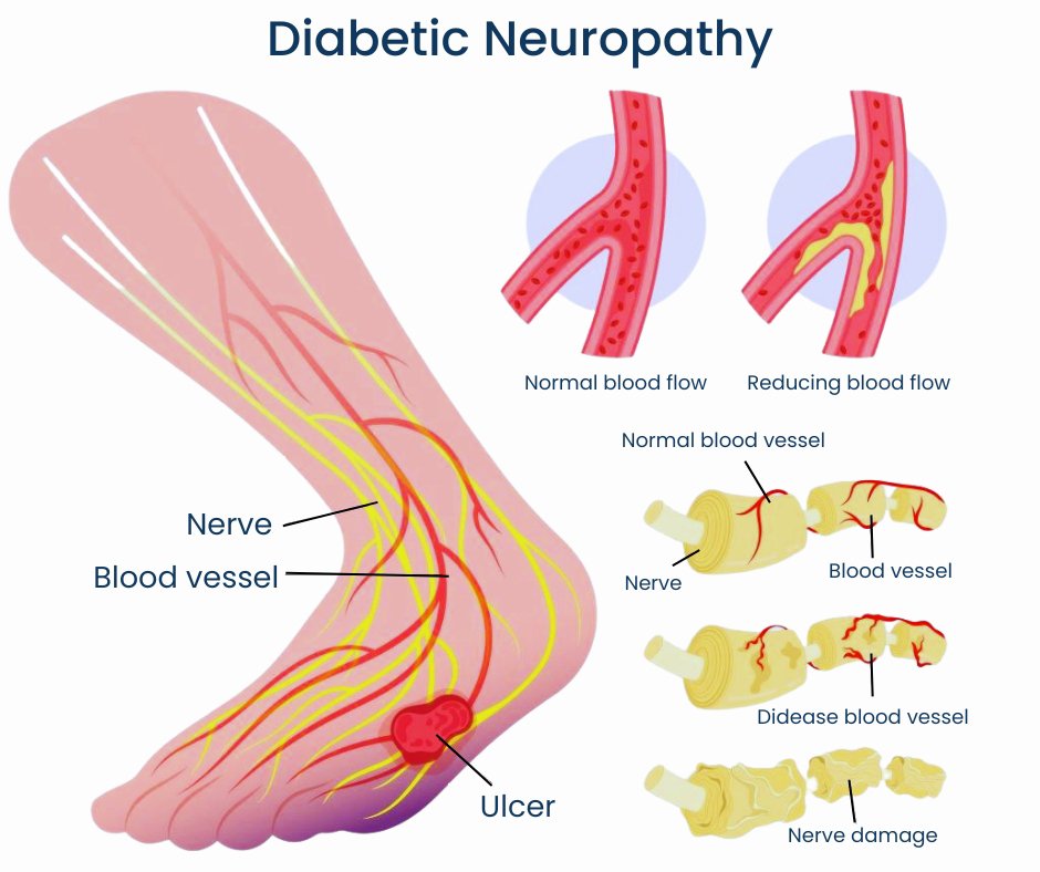 Diabetic Neuropathy