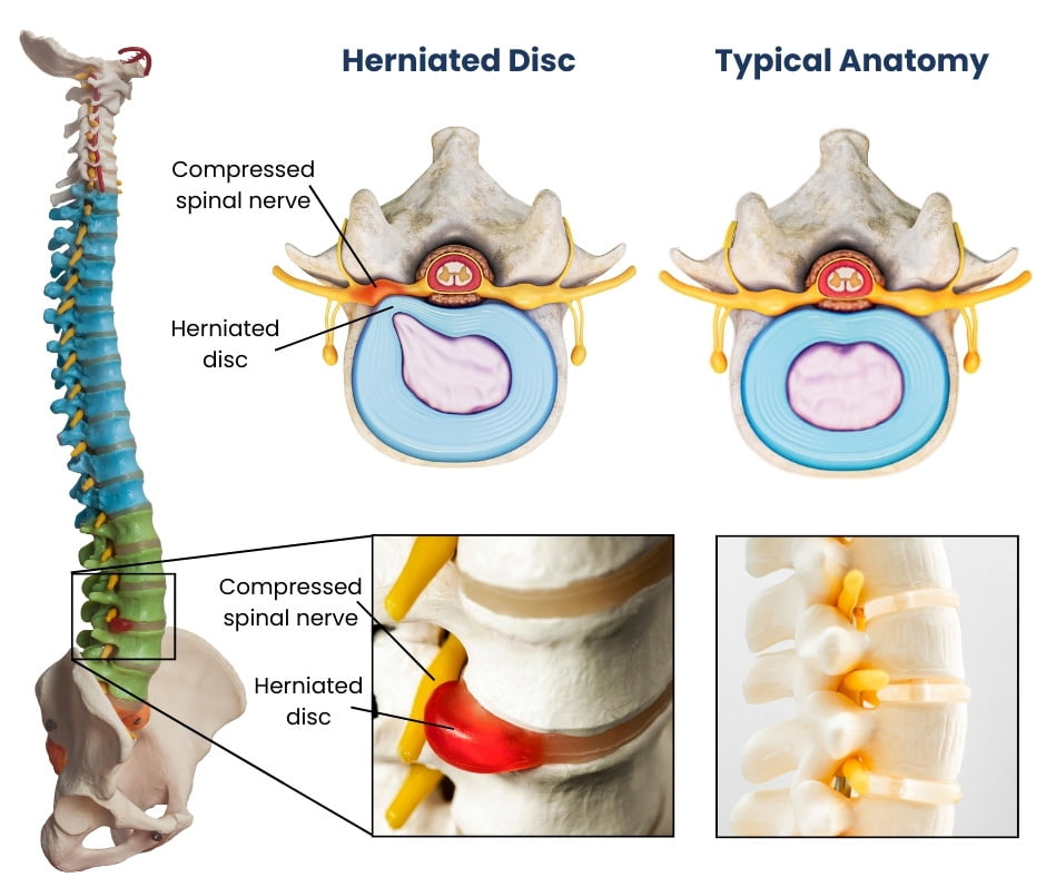 Herniated Disc