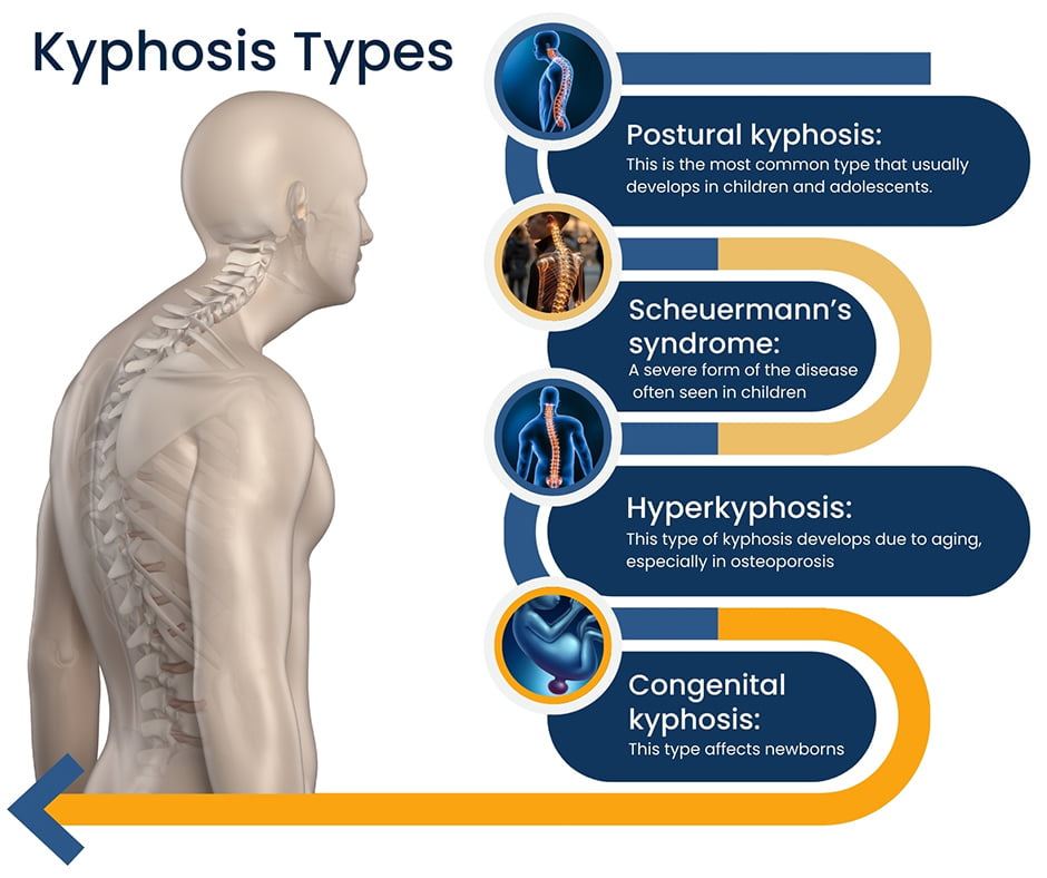 Types of Kyphosis