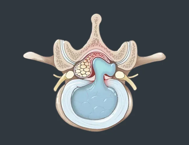 Herniated Discs