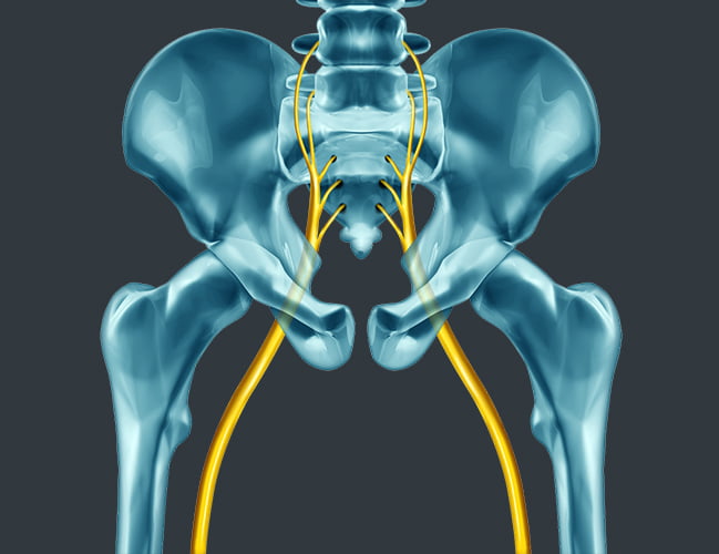 Sciatica
