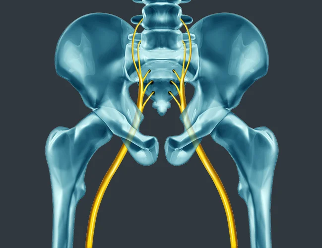 Sciatica