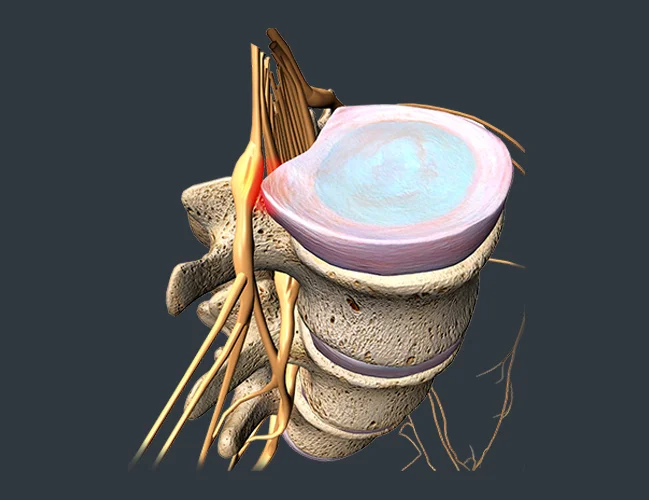 Spinal Stenosis