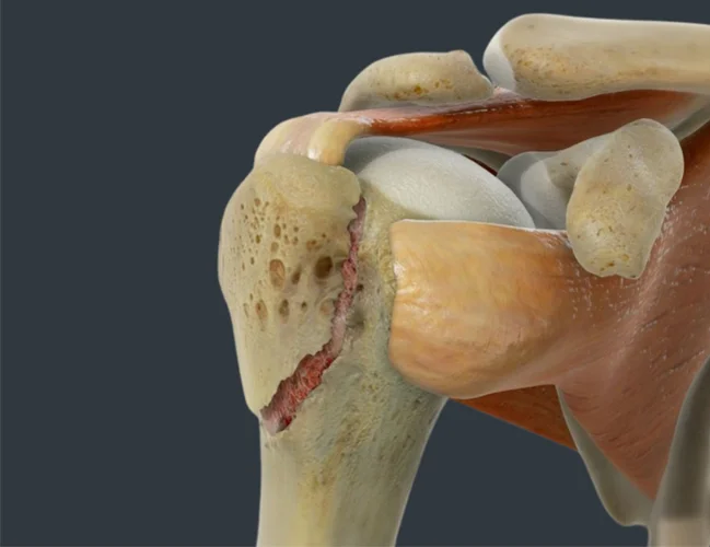 Bone fractures