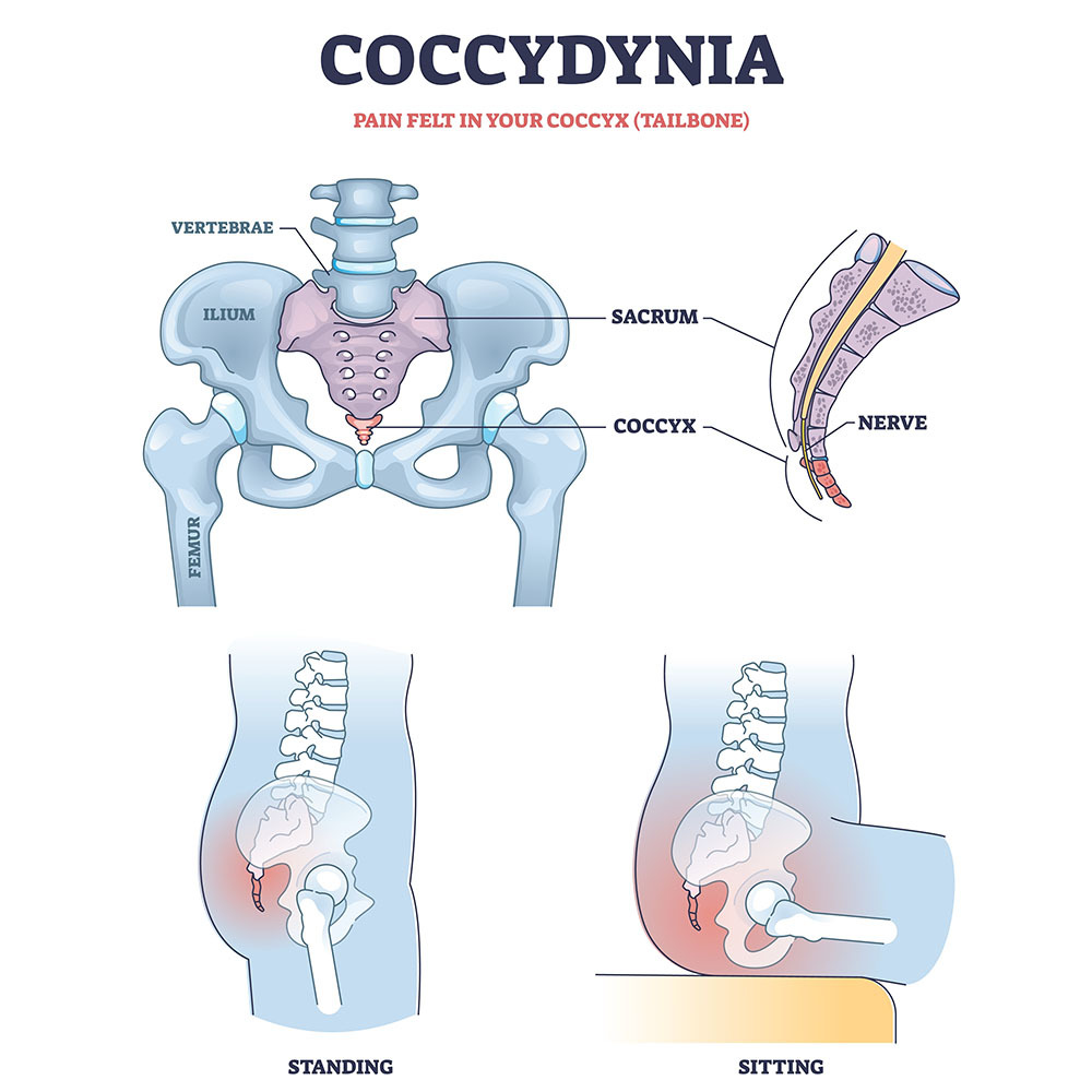 Coccydynia Treatment in NYC
