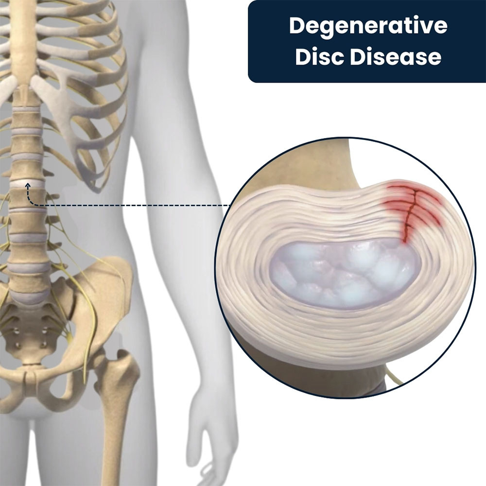 Degenerative Disc Disease Treatment in NYC