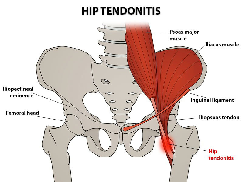 Hip Tendonitis
