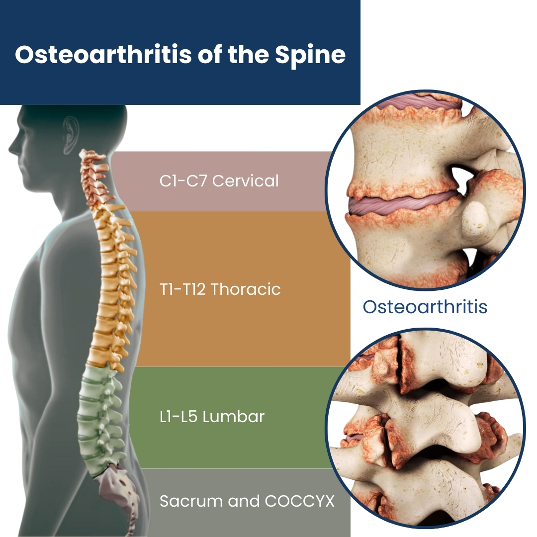 Osteoarthritis of the Spine