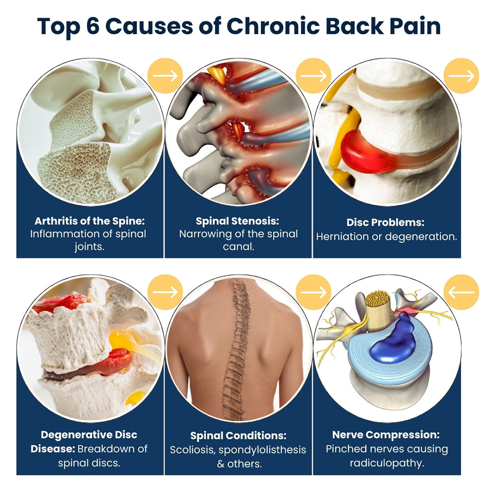 Top 6 Causes of Chronic Back Pain