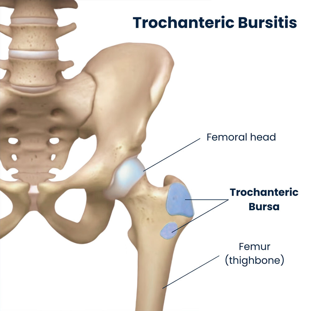 Trochanteric Bursitis