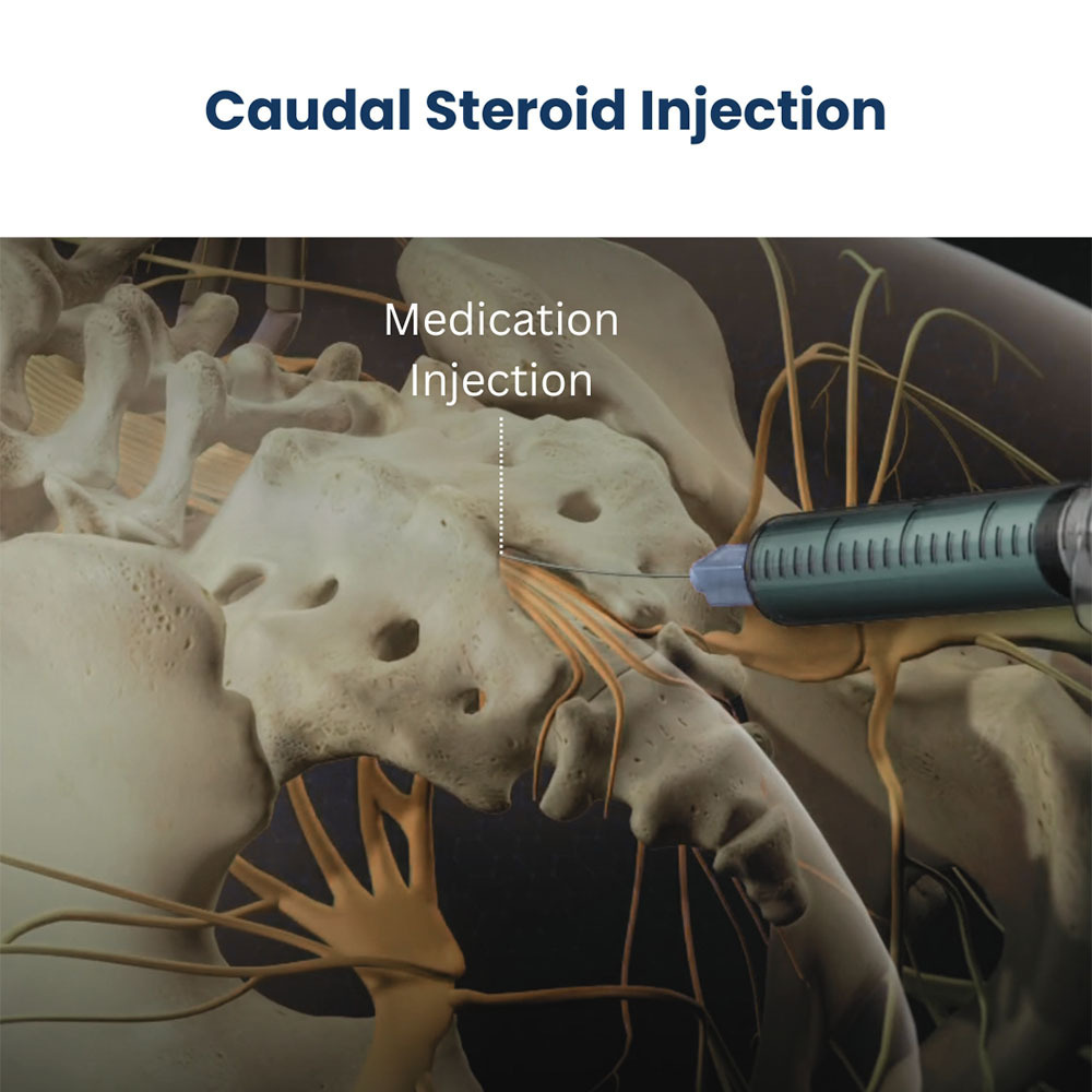 Caudal Steroid Injection