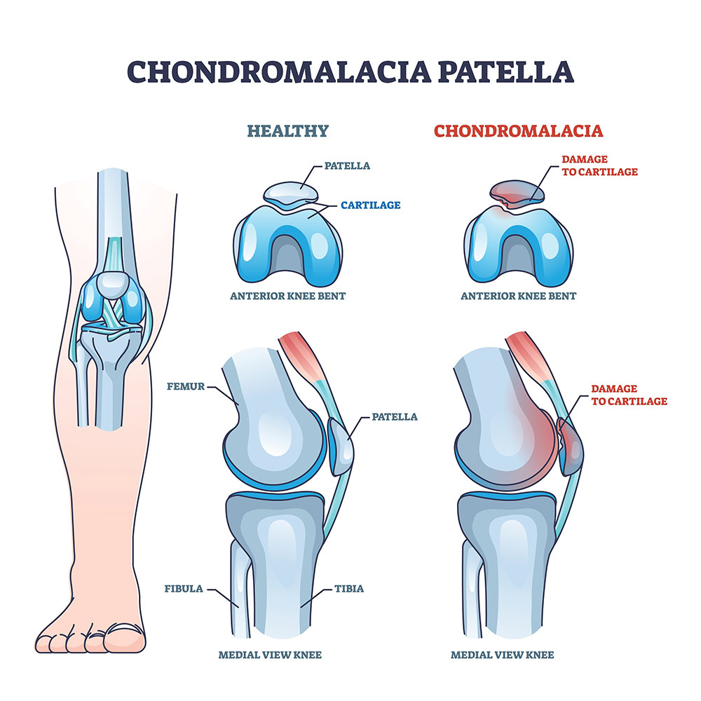 Chondromalacia Patella