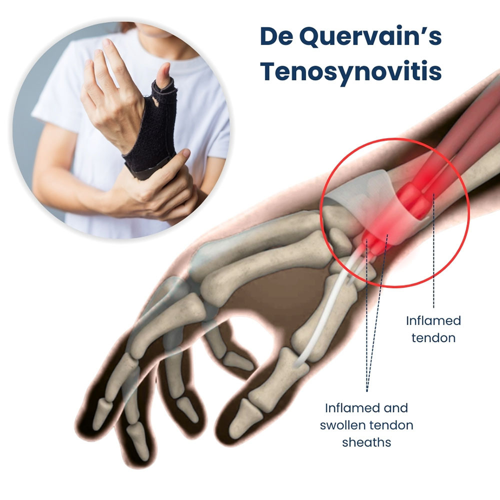 De Quervains Tenosynovitis Treatment in NYC