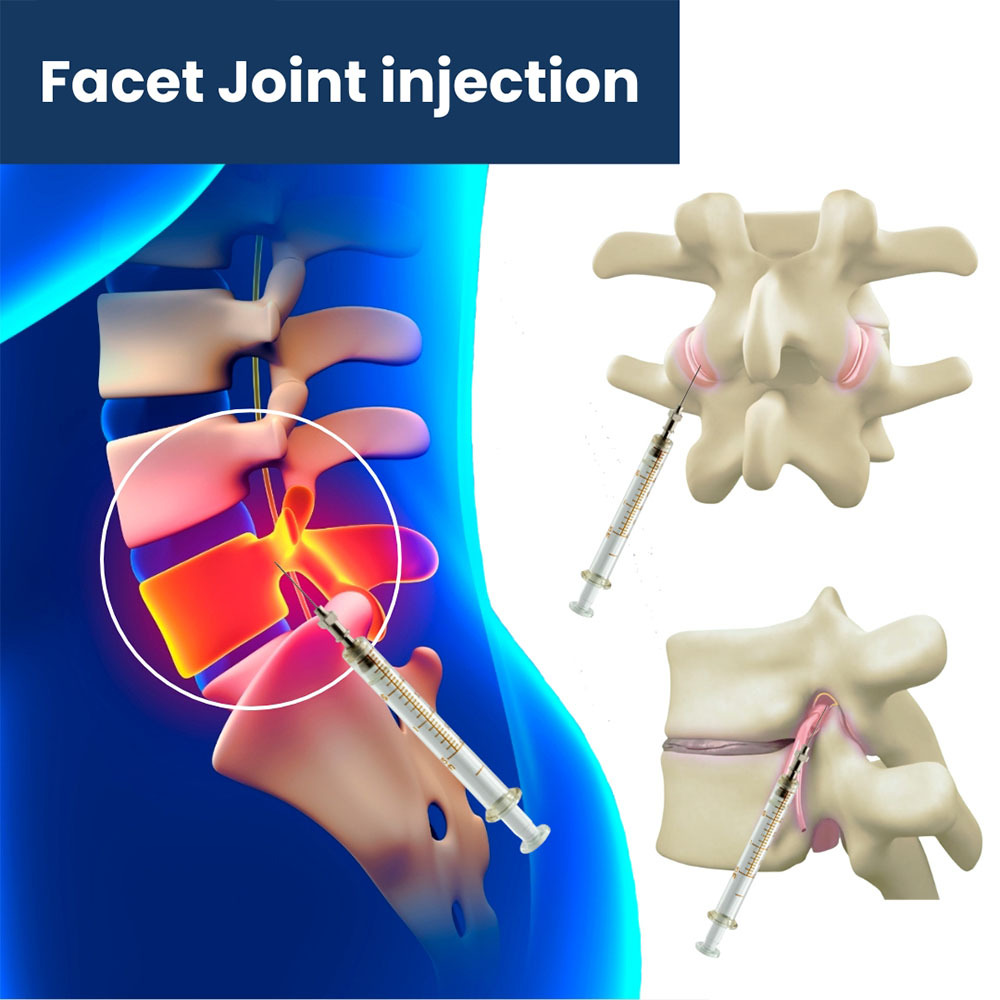 Facet Joint Injections