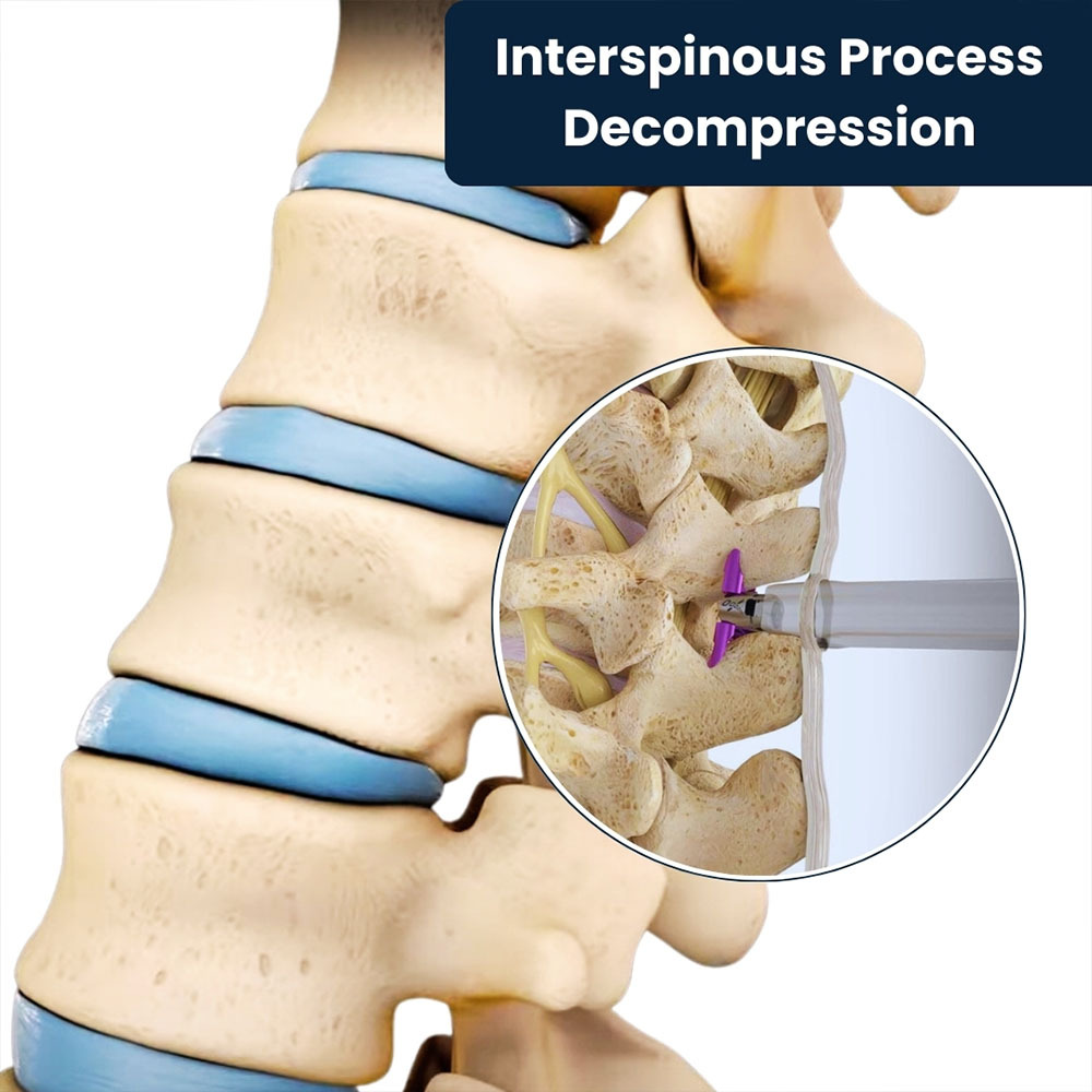 Interspinous Process Decompression