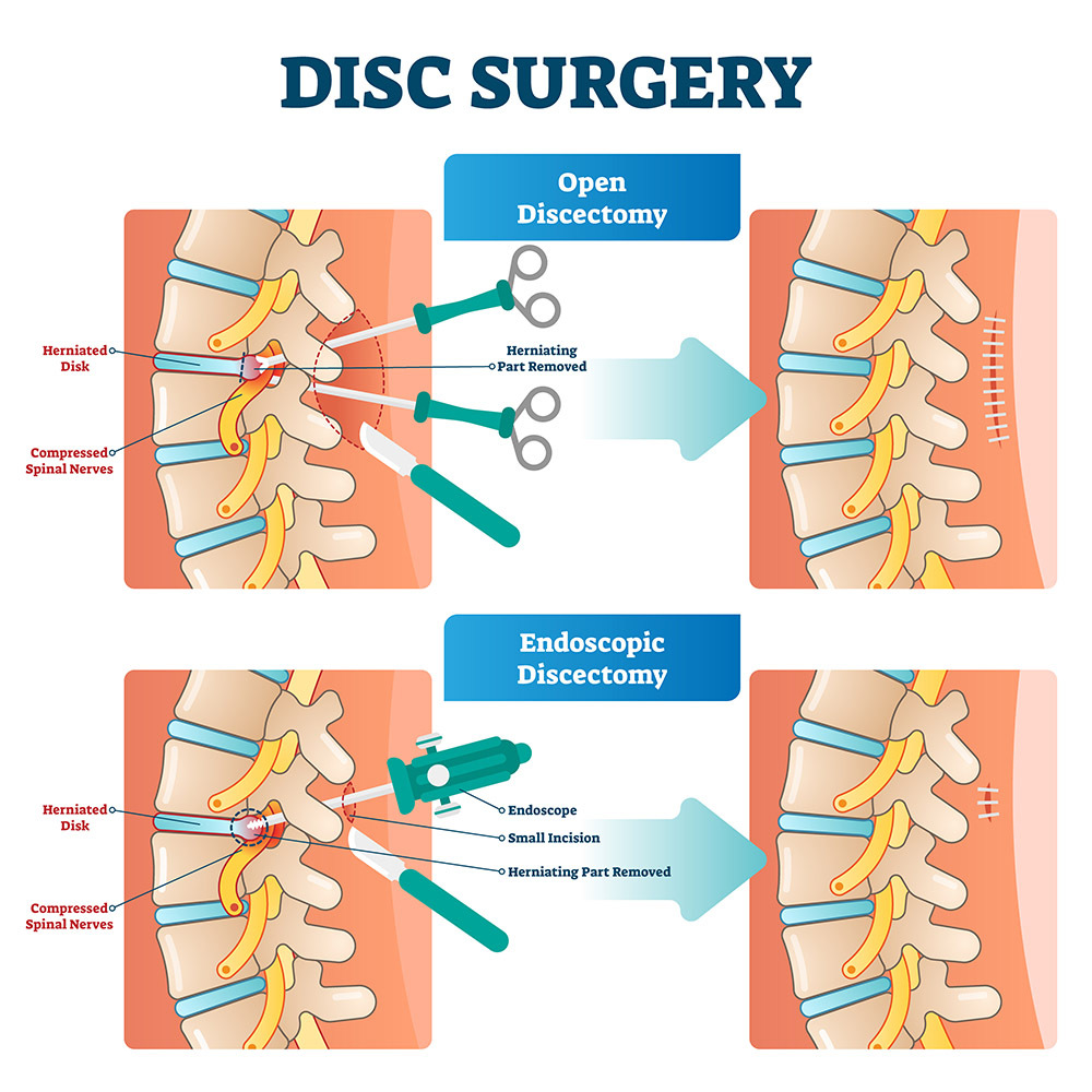Lumbar Endoscopic Discectomy