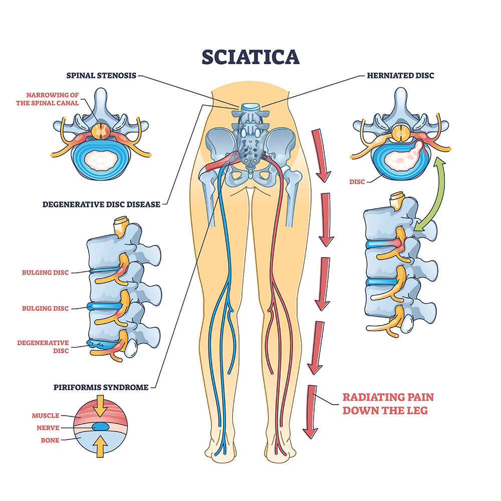 Lumbar Radiculopathy Sciatica Treatment Specialists in NYC