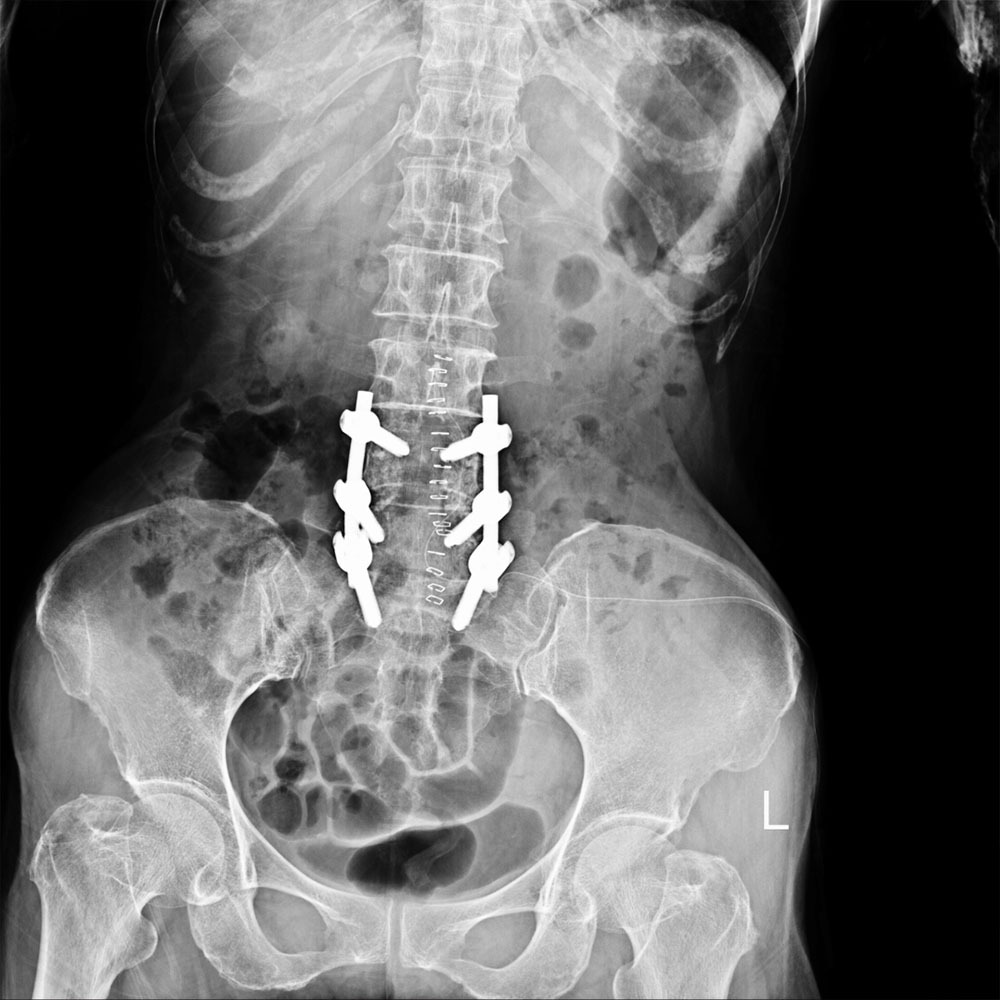 Post Laminectomy Syndrome Treatments in New York