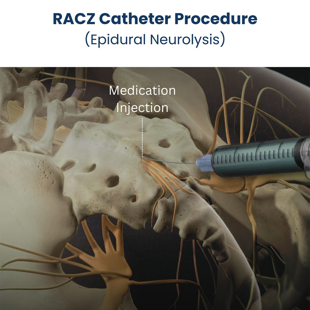 RACZ Caudal Neurolysis